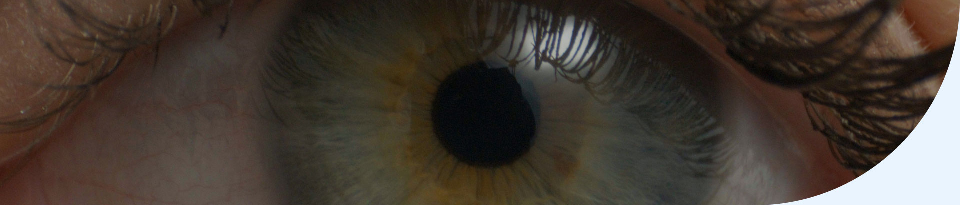 D_Thyroid-Eye-Disease