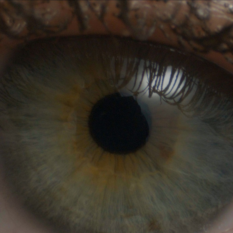 M_Thyroid-Eye-Disease